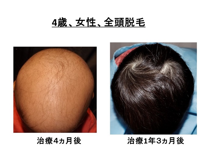 円形脱毛症　病院